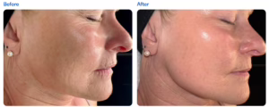 microneedling for smoother skin