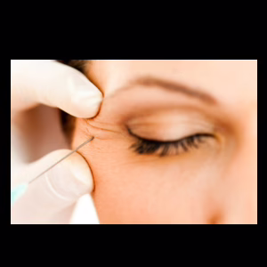 Botox for Crow's Feet