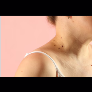 melanoma and skin cancer awareness