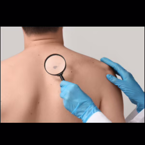 melanoma and skin cancer awareness