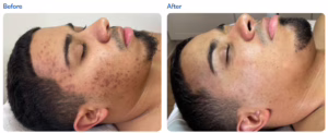 microneedling for healing scars
