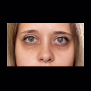 Sleep Is Essential For Healthy Skin